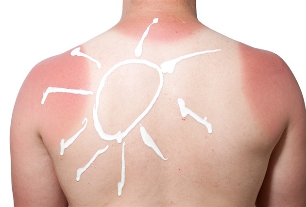 Následky slunění, které nechceme. Jak řešit spálení, alergii i reakci na krém