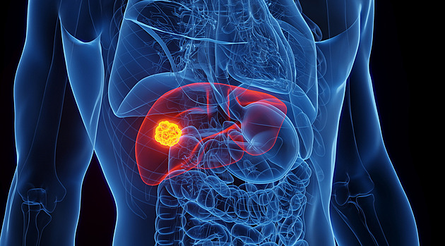 Tlak v břiše, zežloutnutí i hubnutí. Jak poznat varovné signály rakoviny jater